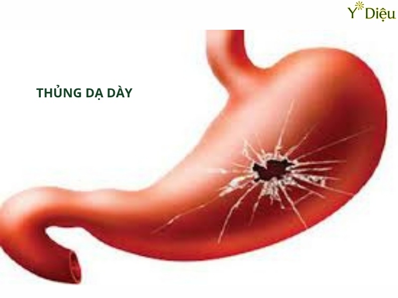 Dấu Hiệu Thủng Dạ Dày: Nguyên Nhân Và Phương Pháp Điều Trị